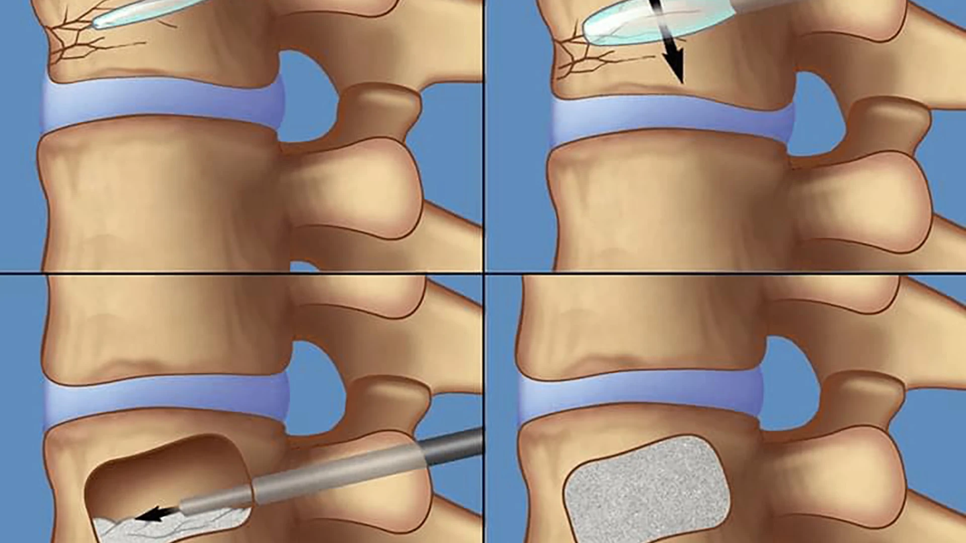 Kyphoplasty treatment at Advanced Pain and Regenerative Specialists, Oceanside, CA